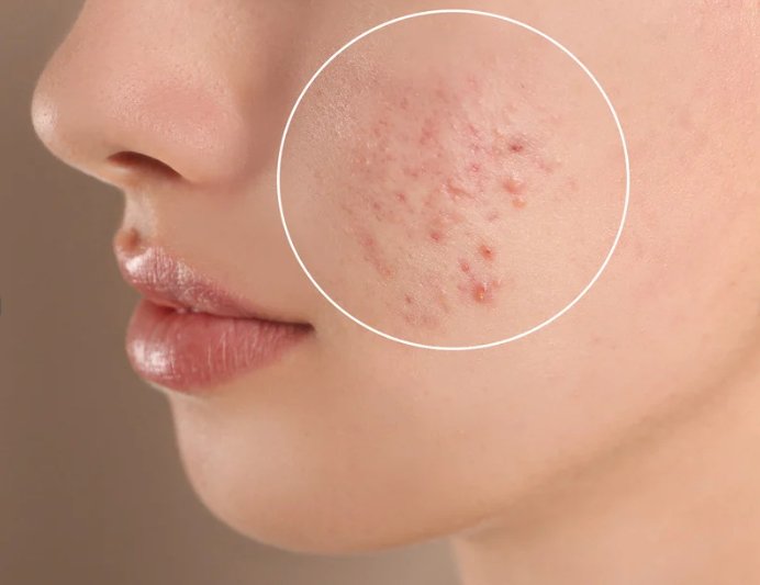 In a Minute: Does Collagen Cause Acne? (Read Time: 1min) - Pinky Collagen